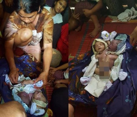 Kasihan bayi kembar di Sumatera ini lahir dengan satu badan dan berkepala dua 1