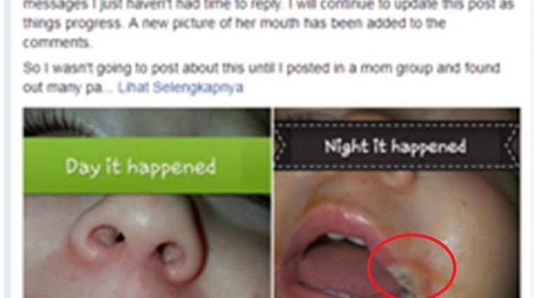 Kasihan masukan charger handphone ke mulut bayi ini alami luka bakar di bagian bibir 2