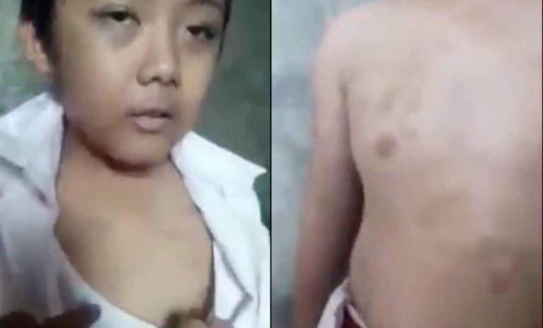 Disiksa ibunya sendiri tubuh bocah SD ini penuh luka lebam akibat pukulan dan disiram air panas