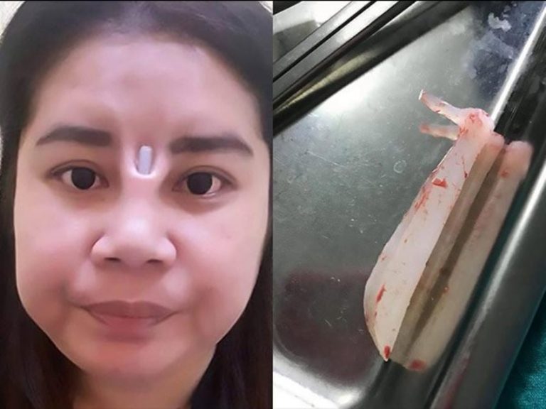 Nekat implan silikon di hidung agar terlihat mancung wanita ini malah dapat musibah