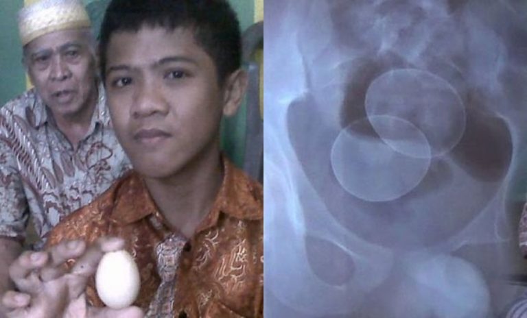 Gemparkan warga remaja asal Gowa ini kembali bertelur hasil foto rontgennya bikin syok