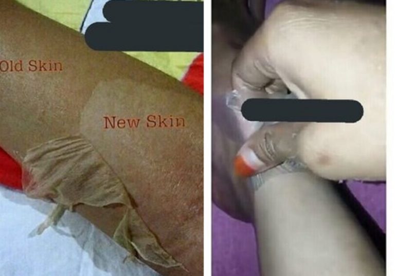 Testimoni produk pemutih kulit ini bikin ngeri sampai ngelupas kaya ular ganti kulit
