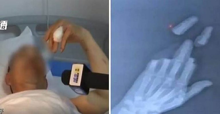 Akibat bermain layangan pada saat cuaca ekstrim tiga jari pria ini putus