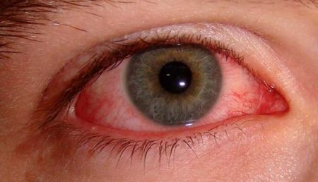 6 efek samping dari penggunaan lensa kontak yang salah