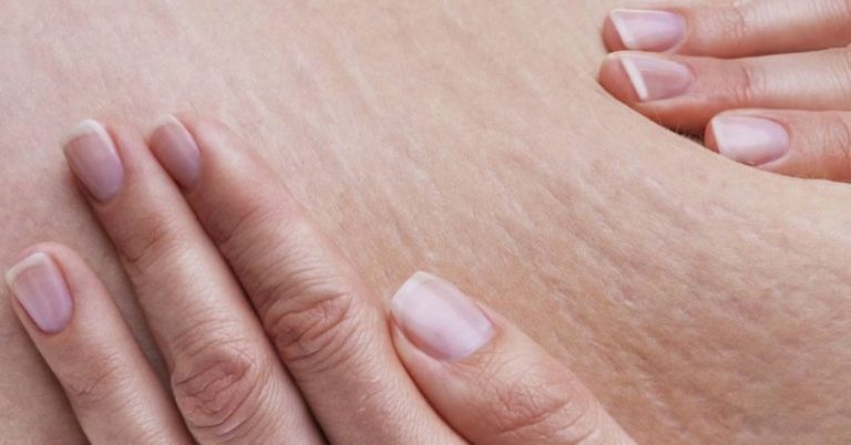 Cara menghilangkan stretch mark secara alami