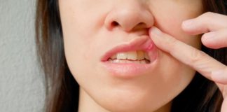 9 Penyebab sering sariawan di mulut