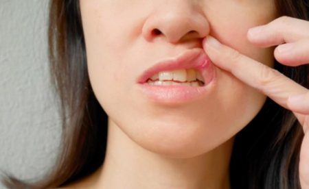 9 Penyebab sering sariawan di mulut
