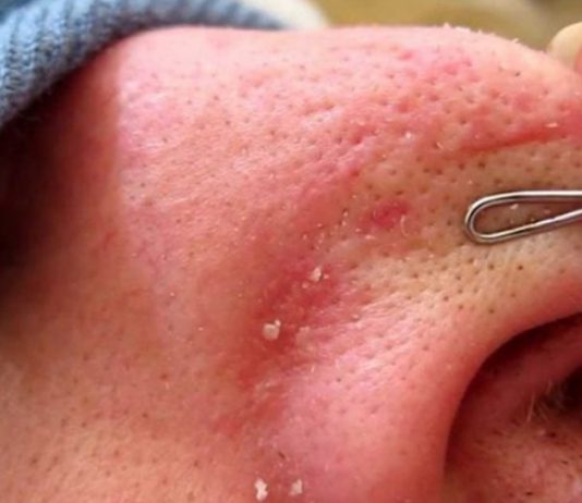 Beragam cara menghilangkan komedo membandel dengan bahan yang alami