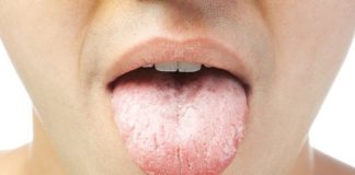 Cara mengobati sariawan di lidah dengan cepat dan mudah!