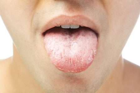 Cara mengobati sariawan di lidah dengan cepat dan mudah!