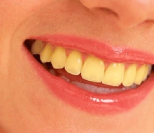 6 Kebiasaan yang menjadi penyebab gigi menjadi kuning