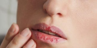 Cara mengatasi bibir kering dan pecah-pecah