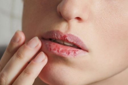 Cara mengatasi bibir kering dan pecah pecah