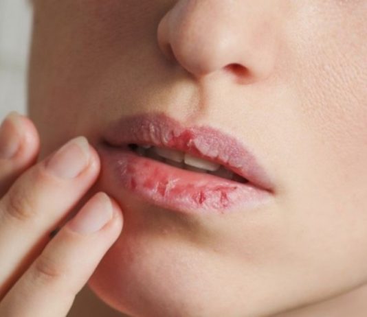 Cara mengatasi bibir kering dan pecah-pecah